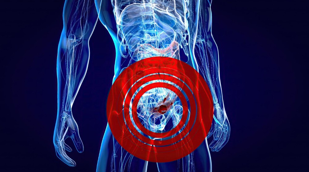 Carcinoma Urotelial: O Que É, Sintomas e Como Tratar