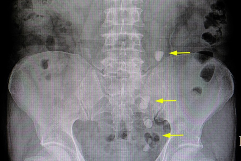 Litotripsia Extracorpórea: Como Funciona o Tratamento para Pedra nos Rins Sem Cirurgia — Cuidado Especializado Faz Toda a Diferença na Urologia Curitiba